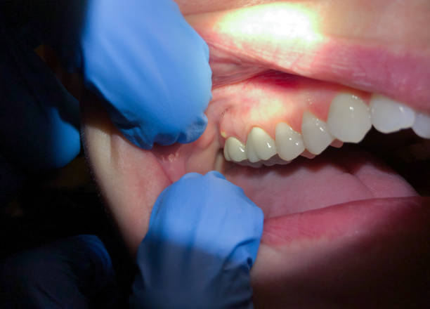 Best Knocked-Out Tooth Emergency  in Fkville, AL