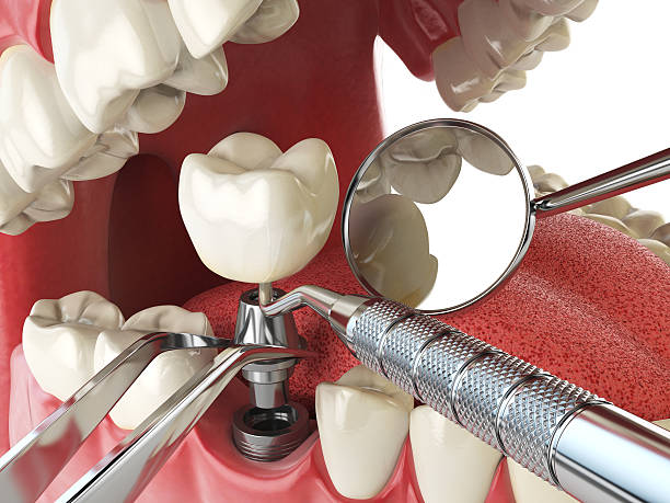 Best Knocked-Out Tooth Emergency  in Fkville, AL